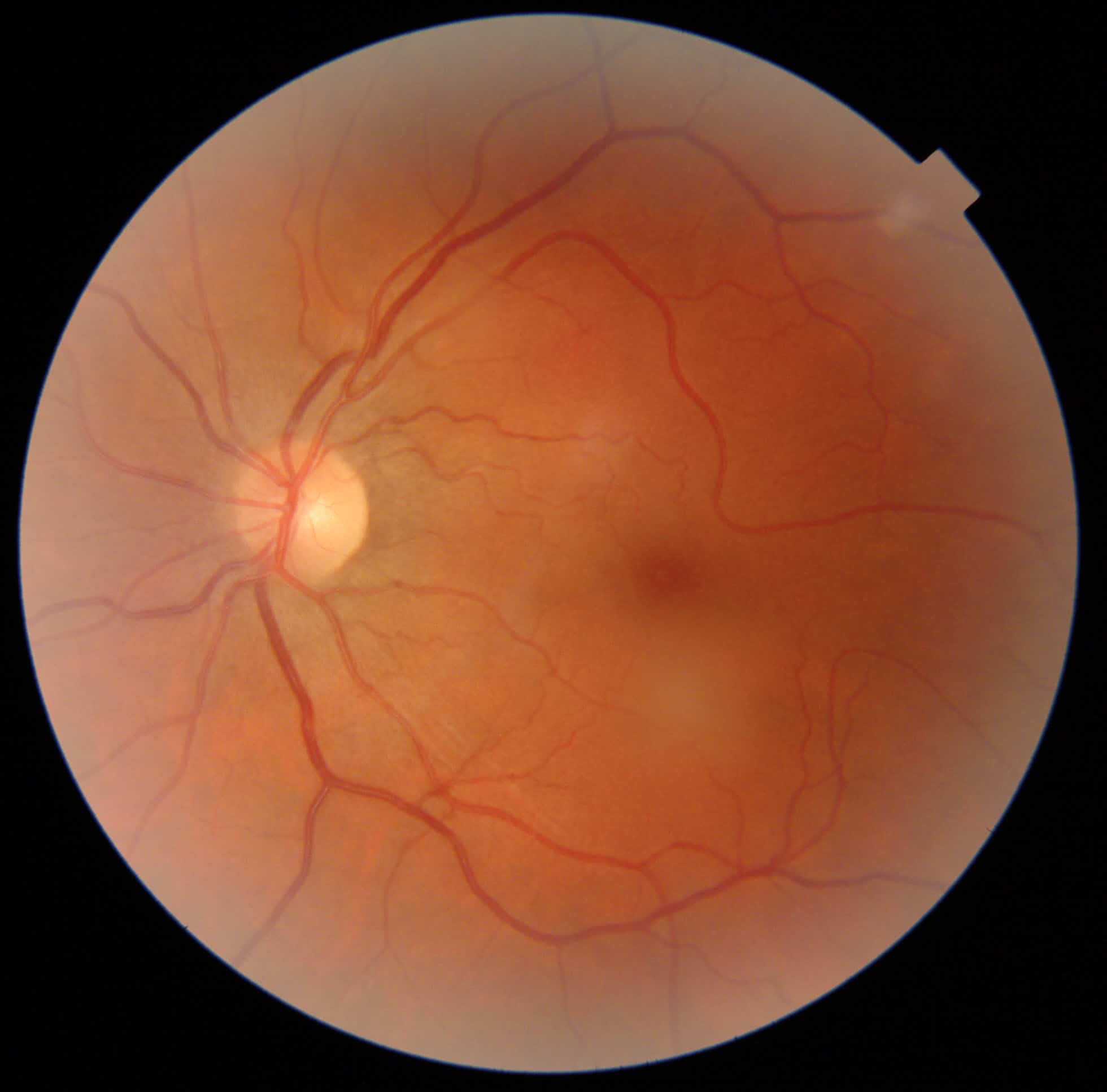 retina