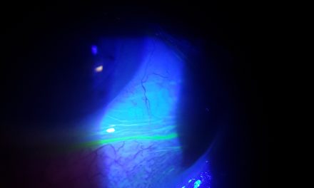 Intolleranza da lenti a contatto