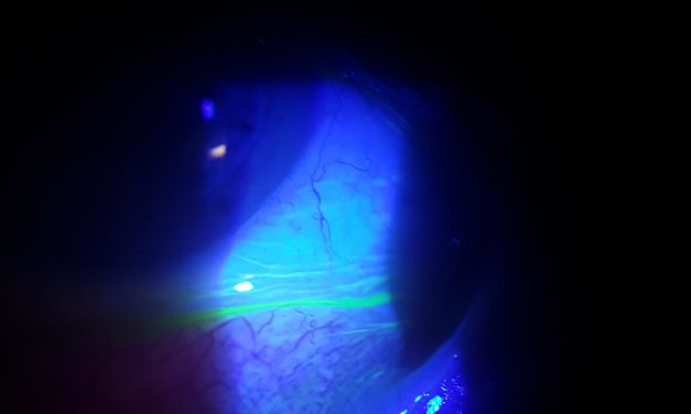 Intolleranza da lenti a contatto