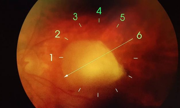 Prevenzione degenerazione maculare senile