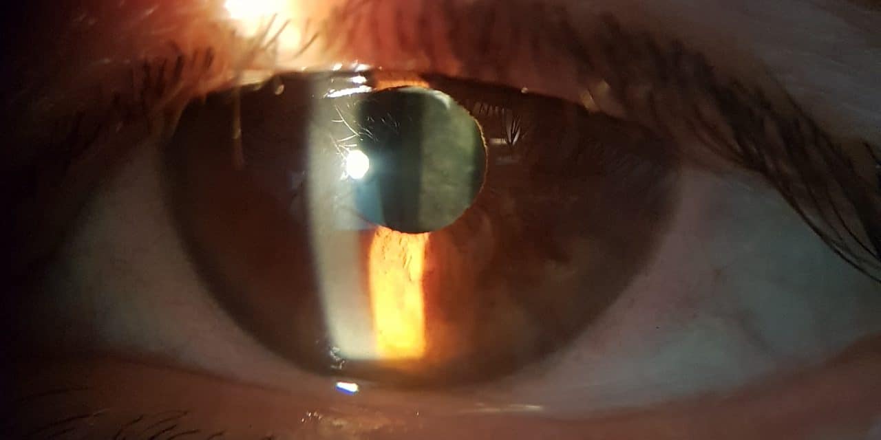 Cataratta secondaria e yag laser capsulotomia