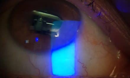 Vernal keratocongiuntivite – cause, sintomi, evoluzione e terapie