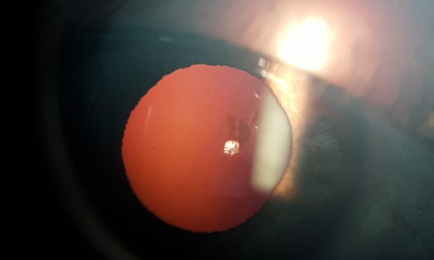 cosa fare dopo l’intervento di cataratta