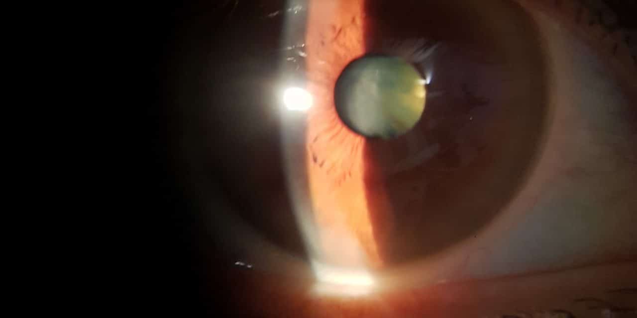 Asse intestino occhio (terza parte): digiuno, trapianto fecale, probiotici