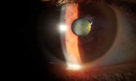 cosa fare prima dell’intervento di cataratta