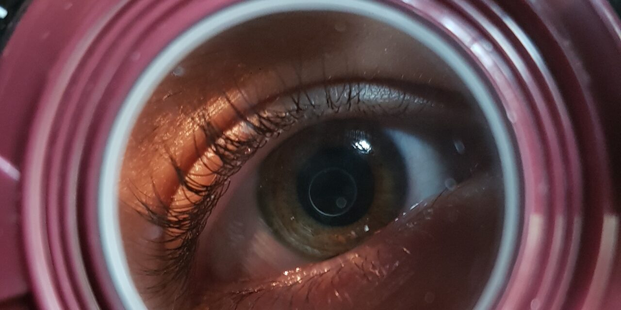 fattori di rischio miopia