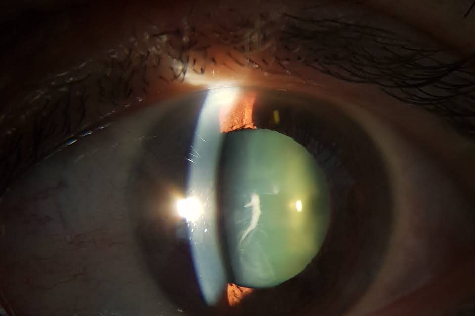 cataratta: cos’è, come si cura, che sintomi dà