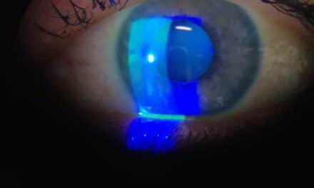 Blefariti e calazi: rimedi cure e terapie naturali