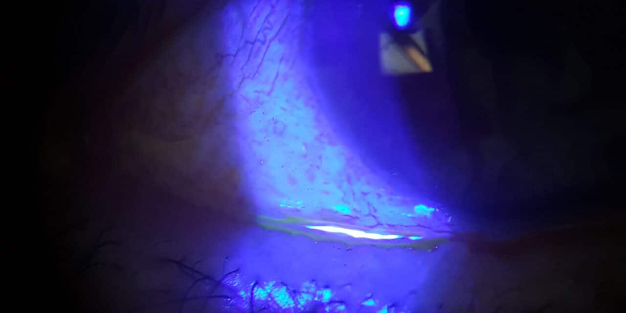 Occhio secco da disfunzione ghiandole meibomio