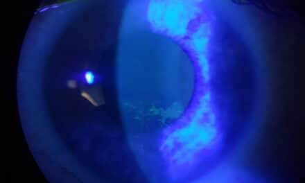 Probiotici per occhio secco: la modifica del proteoma lacrimale