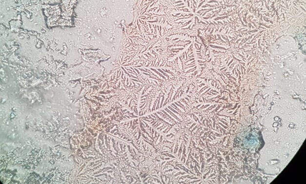 Artrite reumatoide e occhi