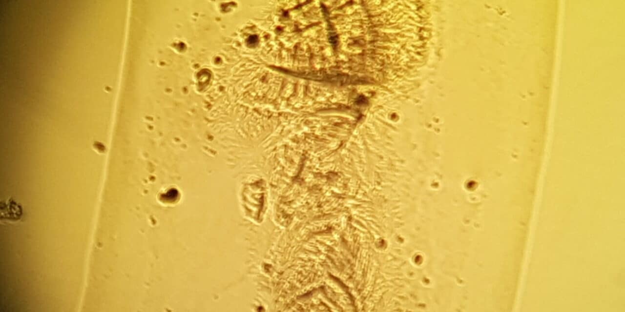 Occhio secco come si cura