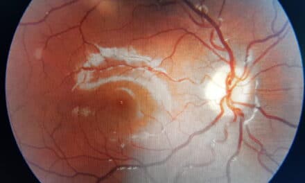Probiotici e occhi: retinopatia diabetica
