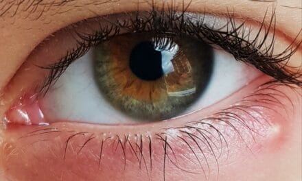 Blefariti, orzaioli e calazi cura e prevenzione