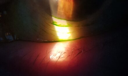 Microbiota in occhio secco e diabete