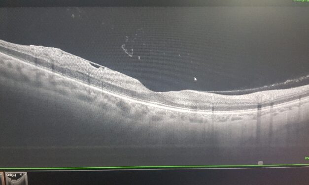 Cause di miodesopsie, corpi mobili vitreali e distacco di vitreo