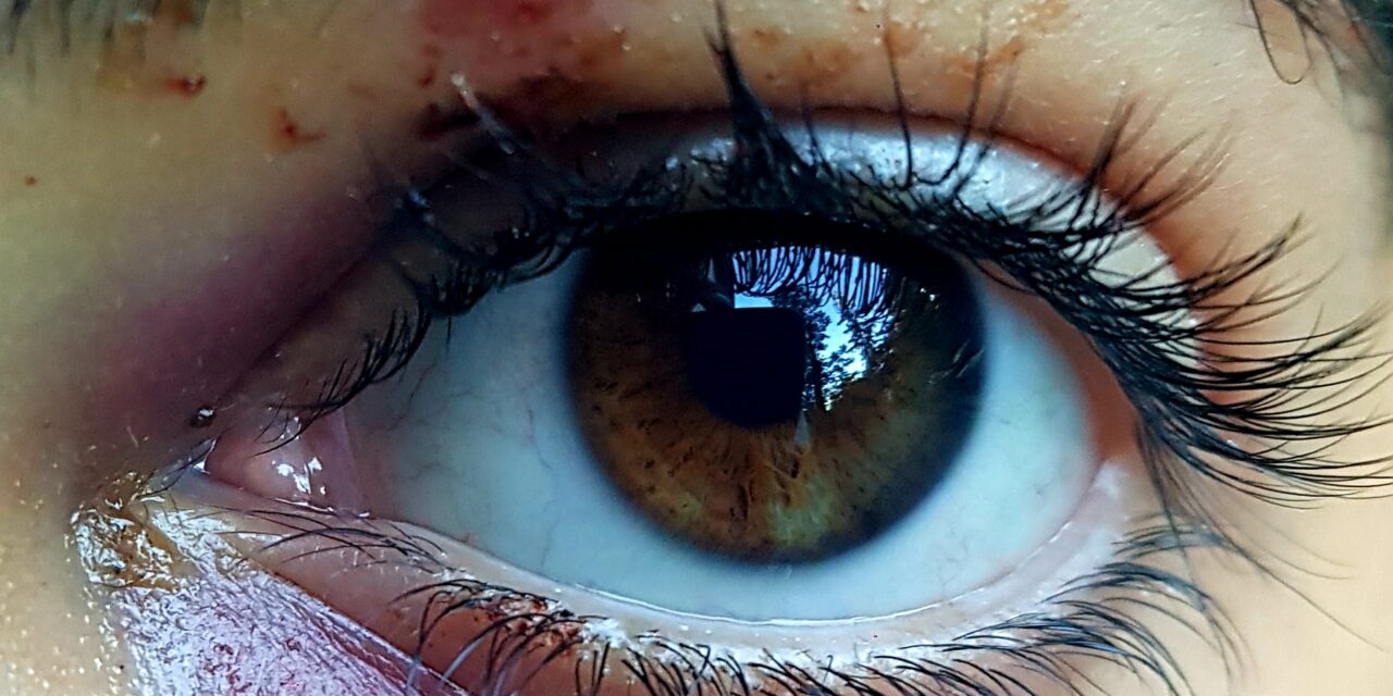 Cosa fare dopo aver preso una botta in un occhio (trauma all’occhio)