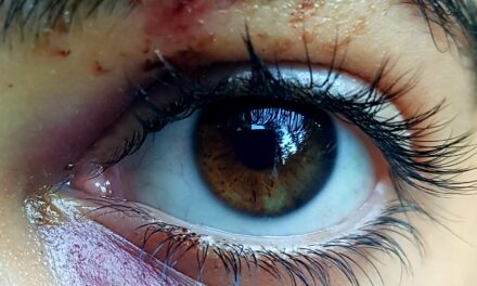 Cosa fare dopo aver preso una botta in un occhio (trauma all’occhio)